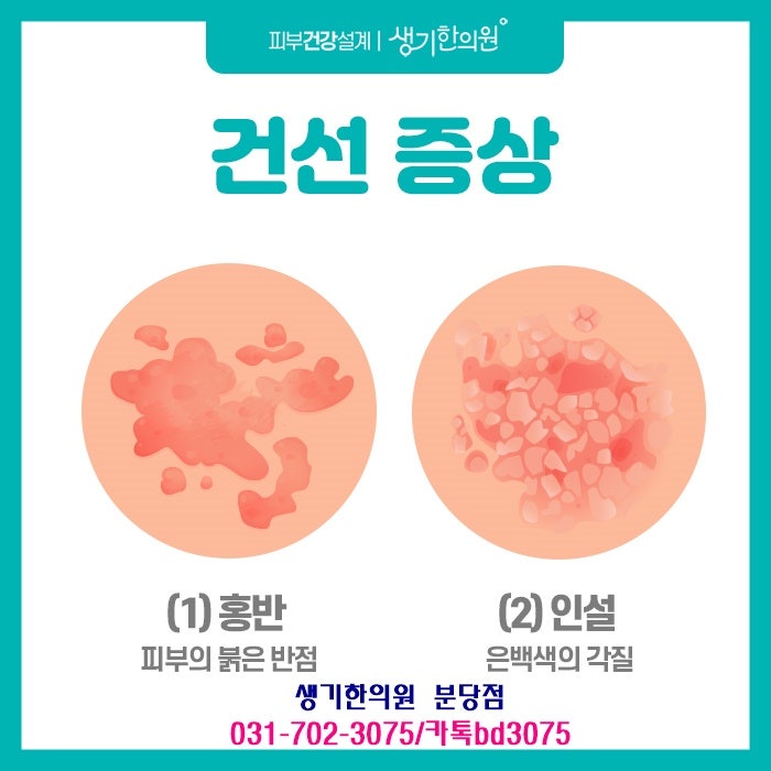 분당 건선한의원, 건선 증상 '이것' 알아두세요