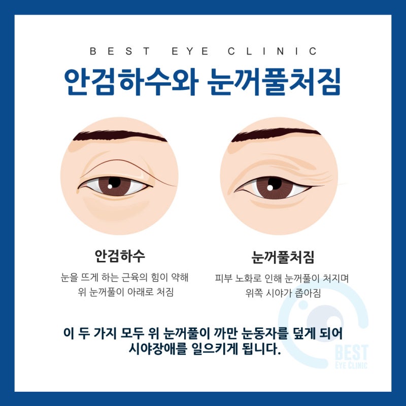 처진눈에 주목하는 대구안검하수안과,이온안과에 대해 알아보도록 하겠습니다.