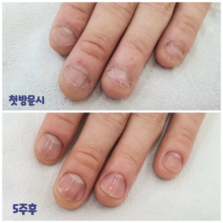 손톱 물어뜯는 버릇을 고칠수 있다구요? 멈출수는 물어뜯는 손톱 5주만에 이렇게 변했습니다./성남수원수지보정동백죽전동/주네일/네일샵무좀파고드는내향성발톱손톱변형푸스케어 손톱 물어뜯는 버릇을 고칠수 있다구요? 멈출수는 물어뜯는 손톱 5주만에 이렇게 변했습니다./성남수원수지보정동백죽전동/주네일/네일샵무좀파고드는내향성발톱손톱변형푸스케어