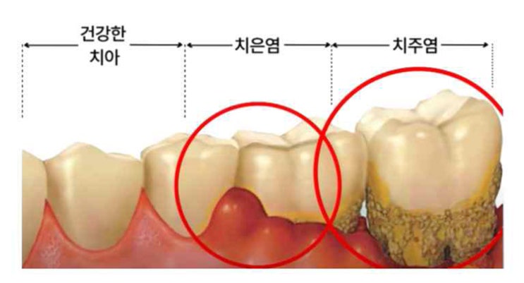  혈액암, 방광암… 흔한 잇몸 염증이 암까지 만든다