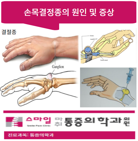  [파주손목염증치료] 찌릿한 손목통증을 일으키는 손목결절종 원인부터 증상 및 치료법