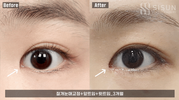팔자주름 제거 제대로 하는 병원 비결 '이것' 6