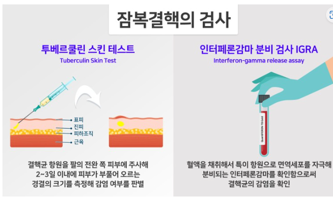 잠복 결핵 감염 진단 이그라 (IGRA)검사 , PPD검사 : 네이버 블로그