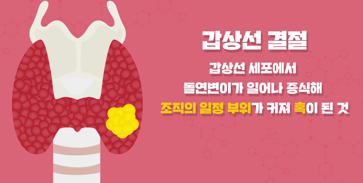  갑상선 양성 결절(benign nodule) - 병원 진찰 과정, 갑상선 여포성 선종(thyroid follicular adenoma), 갑상선 낭종(thyroid cyst)