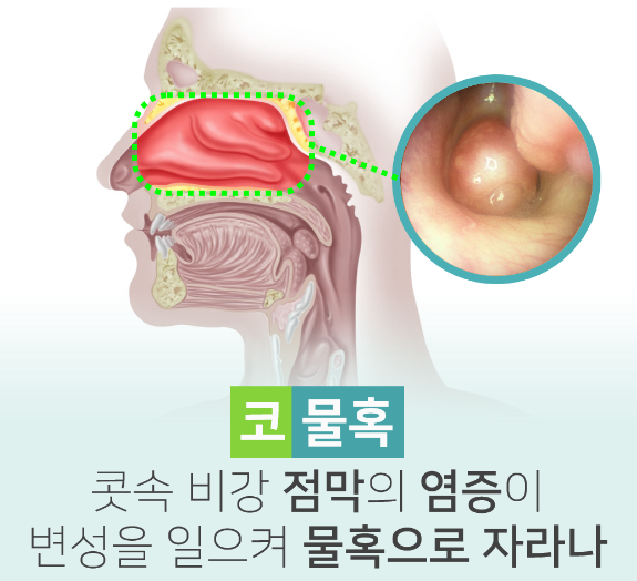  비용종(비용, Nasal polyp), 비용종증(Nasal polyposis) - 코 안에 물혹이 생겼어요