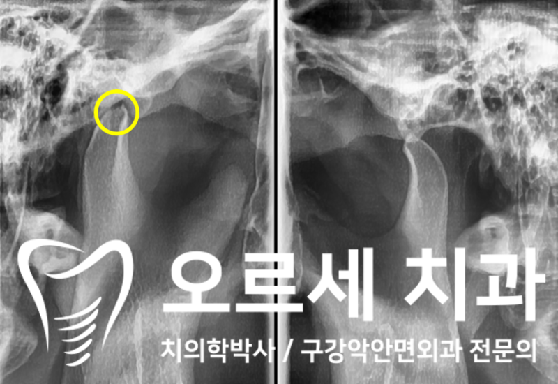 턱 빠짐 때문에 대학병원 가려다 오신 분들의 경우 : 네이버 블로그