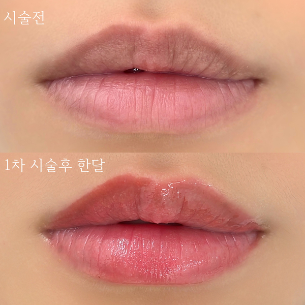  전국에서 찾아오는 어두운입술 검은입술 입술색소침착 무통증 입술문신 유명한 곳 liptattoo darklips korealiptattoo