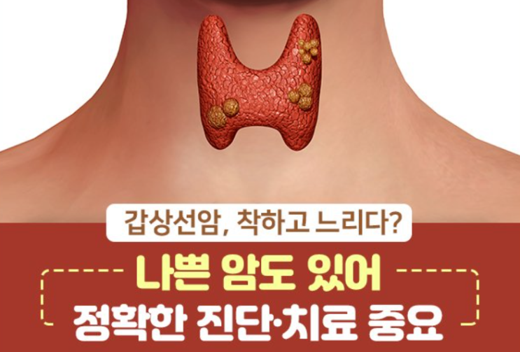  갑상선의 악성 종양 (1) - 갑상선암(Thyroid cancer) - 발병 빈도, 종류, 관련된 유전자, 진단 검사법, 예후 인자, 병기(AJCC 8판 Stage)