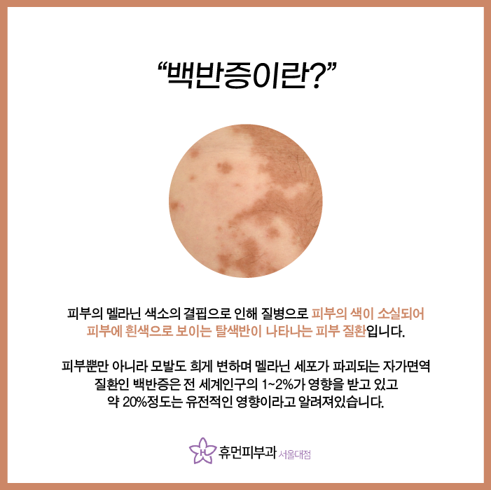 서울피부과추천 백반증은 어떻게