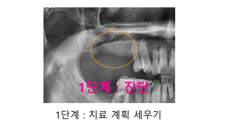  미사치과 - 임플란트 전 치료 과정을 알아봅시다