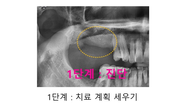 미사치과 - 임플란트 전 치료 과정을 알아봅시다