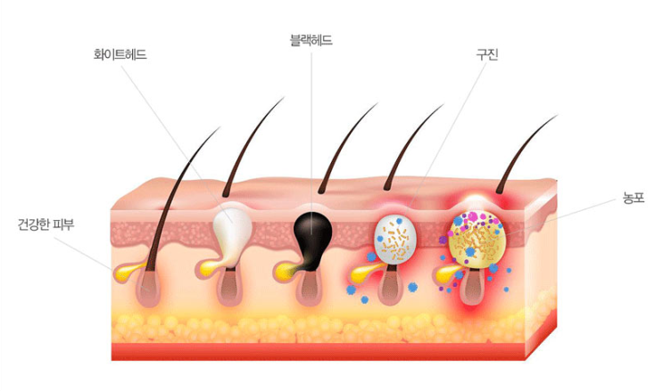  응괴성,구진성,면포성 얼굴 여드름 원인과 해결법