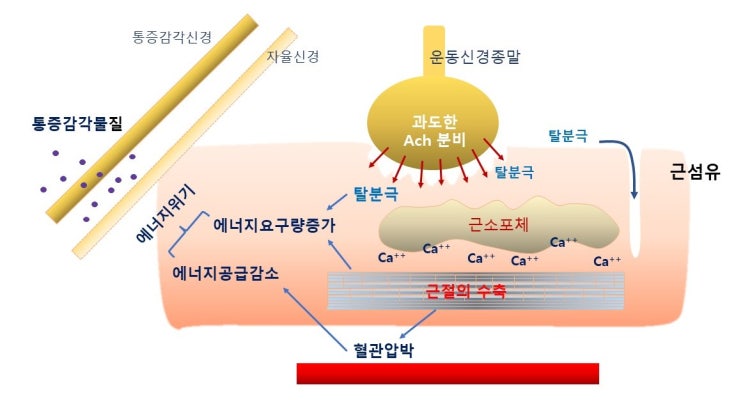  근막통증증후군(myofascial pain syndrome) 원인과 대처, 통증유발점(Trigger point),긴장띠(Taut band),연관통(Refered pain)