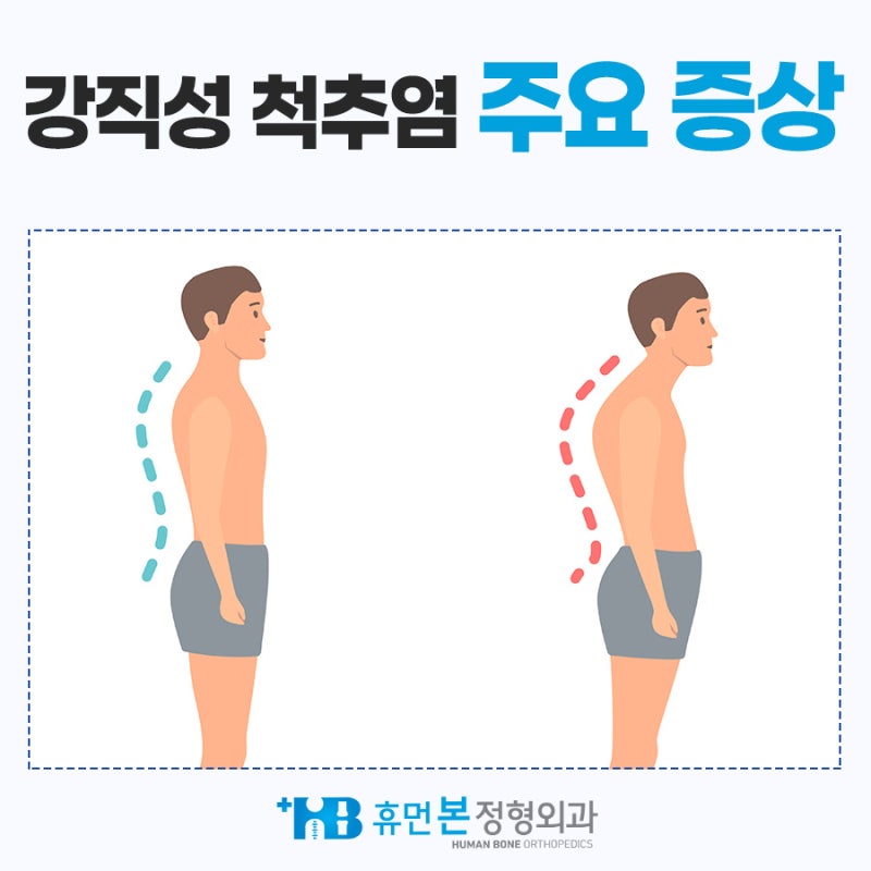 강직성척추염 운동치료 인천 부평 6