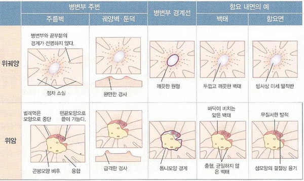 위암 분류, 초기 증상, 위내시경 진단 및 치료 : 네이버 블로그