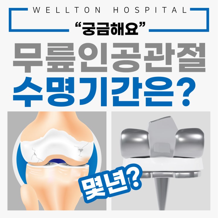  내몸에 적용되는 무릎 인공관절 수명 기간은?