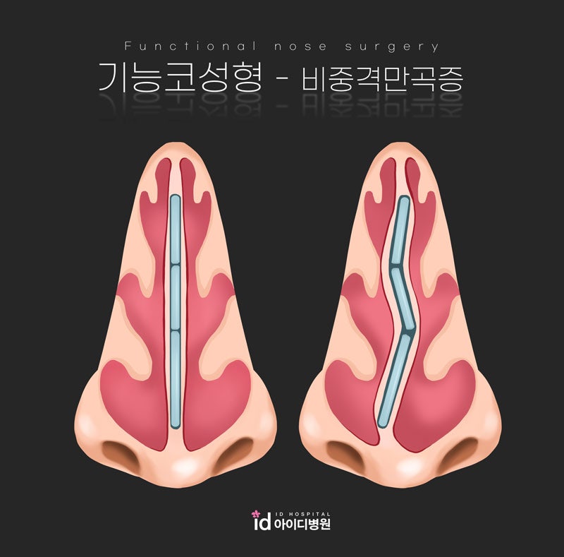 기능성 비성형술 비용 중요한 요소