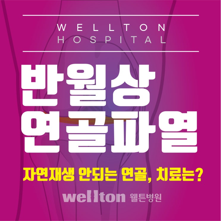  무릎연골파열 염증이 더 커지기전에 치료 : 부분절제술