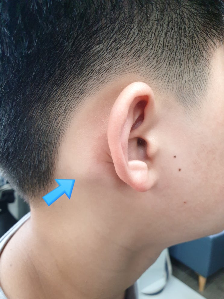 귀뒤 멍울 뼈 혹 염증 통증 병원다녀온후기