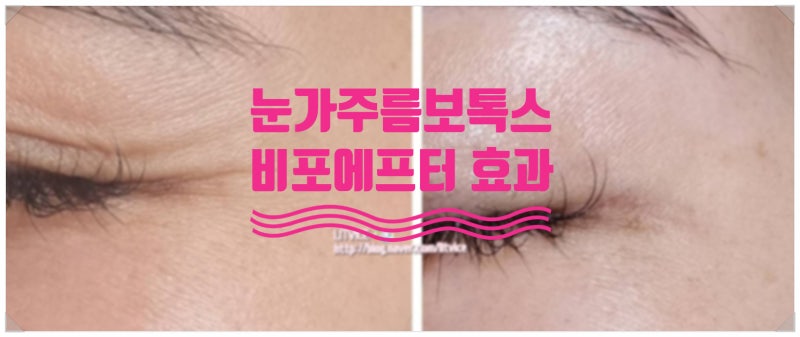 광주 눈가 보톡스 노안 원인 주름 바로잡기 5