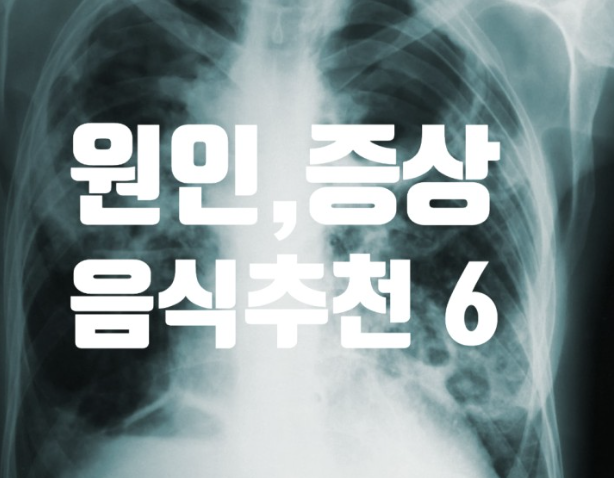 결핵 증상, 결핵 원인 , 결핵에 좋은 음식 6가지