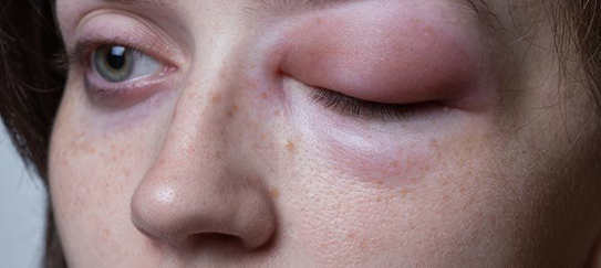 몸 부종 원인 혈관부종, 맥관부종 : 얼굴 손 발 다리 하체 붓기 부종 원인 : 네이버 블로그