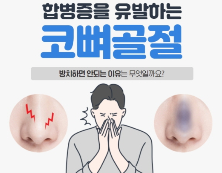  코뼈 골절, 비골 골절(Nasal bone fracture) - 코뼈가 부러졌어요