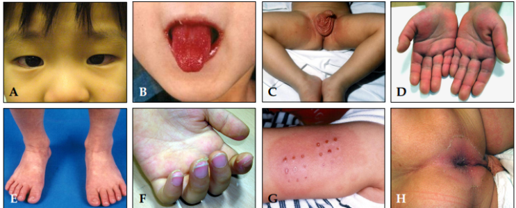  고열, 발적, 눈 충혈, 딸기혀를 보이는 아이, 가와사키병 (Kawasaki disease)(A to Z) (소아과 의사가 다 알려드림)
