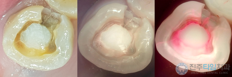  신경치료 후 방치한 치아 #충치 #크랙