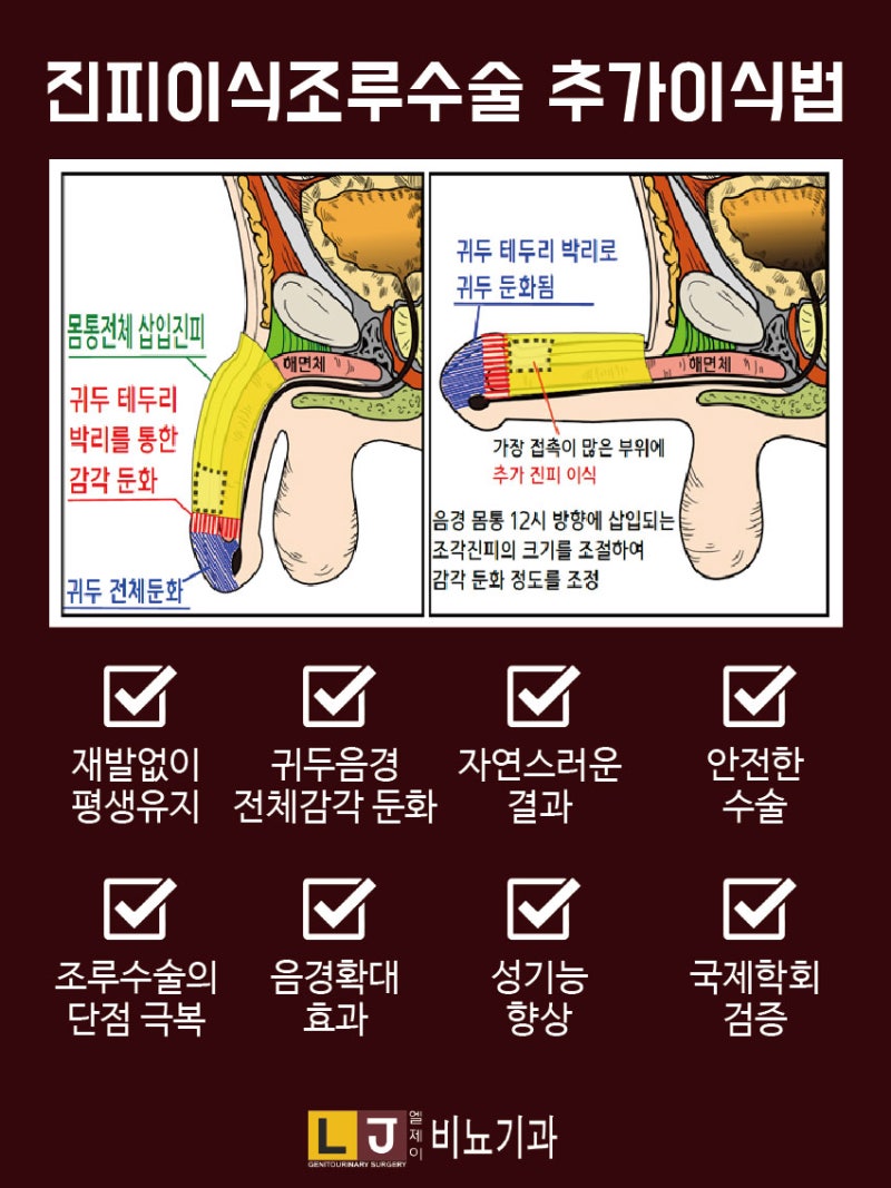 진피이식 조루수술의 추가 이식법이 확실한 해결책