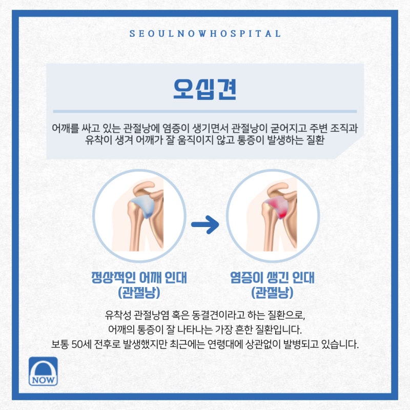 어깨 통증에 좋은 주사 치료와 어깨 관련 증상을 살펴볼 것. 2
