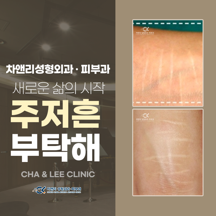  자해흉터, 주저흔처럼 안보이게 하려면