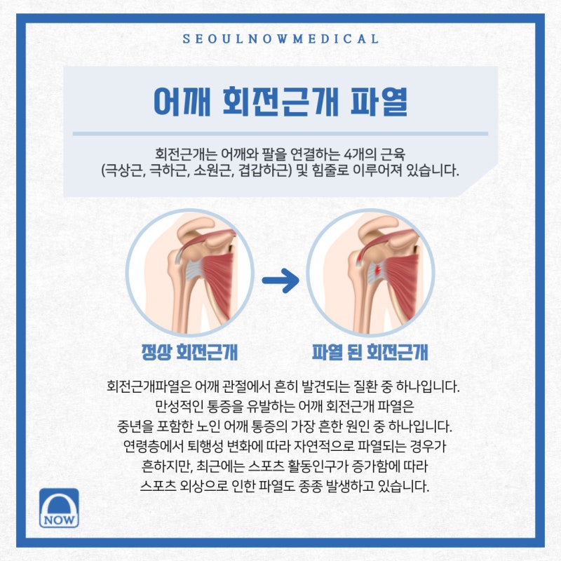 어깨 통증에 좋은 주사 치료와 어깨 관련 증상을 살펴볼 것. 3