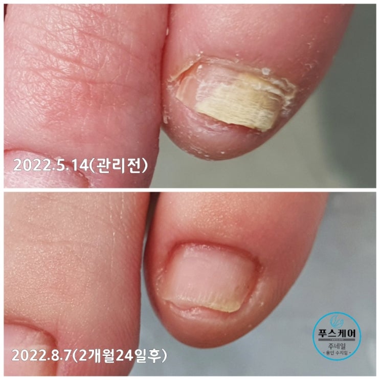 새끼발톱 무좀때문에 양말을 벗을수가 없어요. /성남수원수지보정동백죽전동/주네일/무좀발톱염증파고드는내향성발톱손톱변형전문점