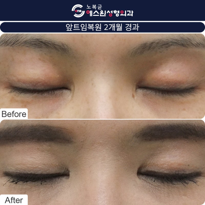 젠틀맨성형외과에서 눈꼬리 교정으로 부자연스러운 눈매교정