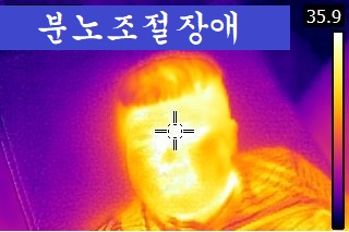  분노조절장애 치료, 상체열이 있는 경우