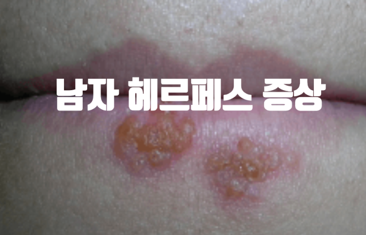  남자 헤르페스 증상 구체적인 파악 후 해결해요