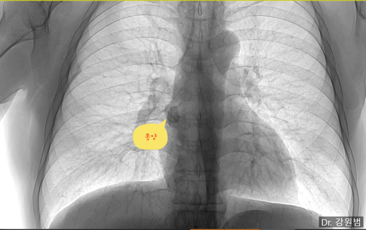  등이 계속 결리고 아파요, 반복되는 등통증 반드시 X-ray! (부산)