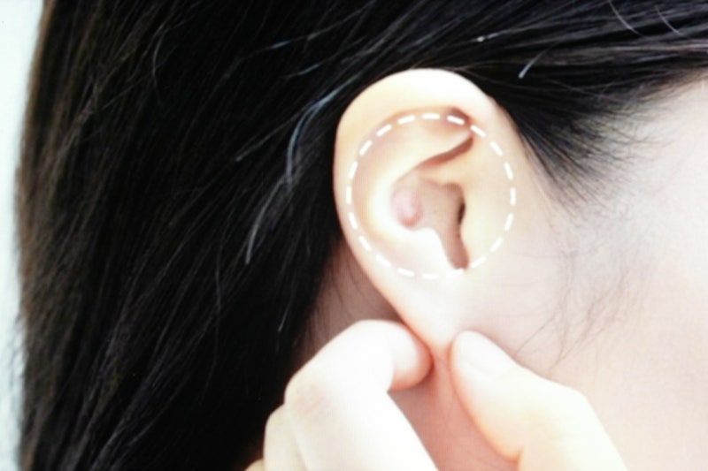 표피낭종 원인, 수술 방법 : 네이버 블로그