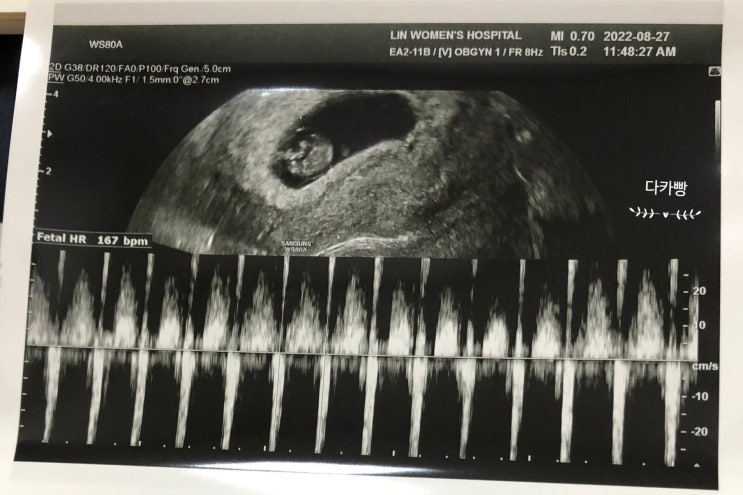 린여성병원 초진 초음파하고 왔어요