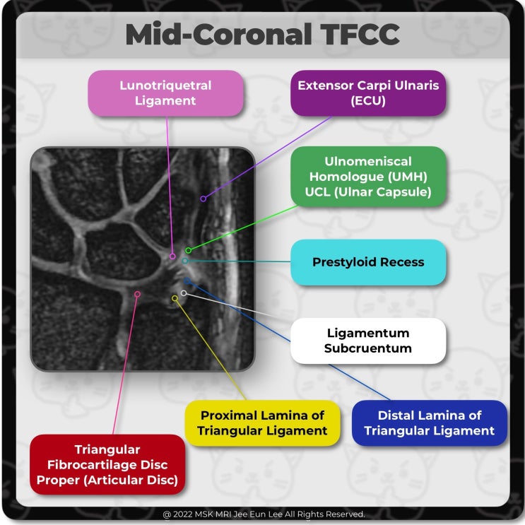  [Anatomy_16] Radioulnar Component of ulnomeniscal homologue, TFCC, wrist MRI