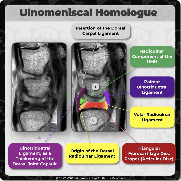  [Anatomy_17] Ulnomeniscal homologue, Radioulnar Ligament TFCC, Ulnotriquetral Ligament