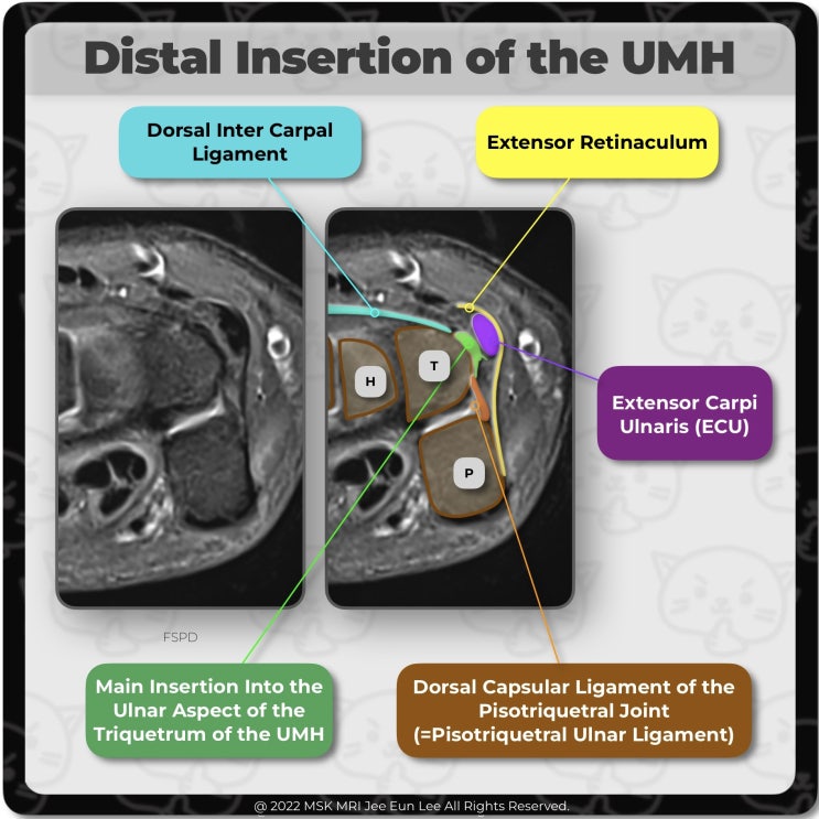  [Anatomy_19] Distal Insertion of the ulnomeniscal homologue, TFCC, wrist MRI