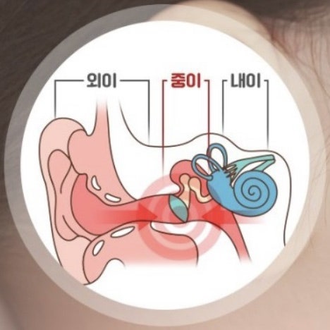 간호사가 알려주는 소아 아기 어린이 중이염 7단계 증상 원인 치료 예방법