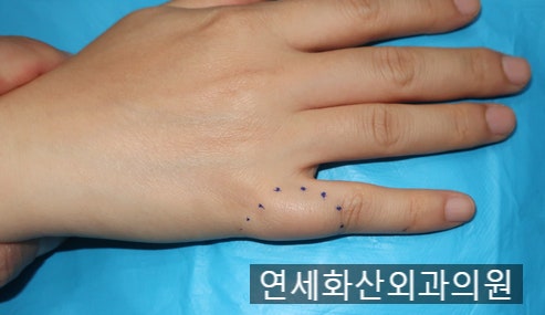 [송파 피부종양 수술] 손가락에 6
