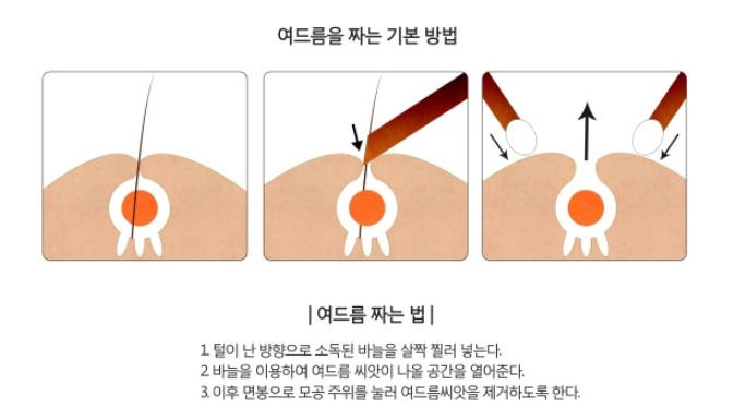  여드름바늘과 여드름압출기로 여드름 압출,여드름제거 / 여드름짜기 + 관리