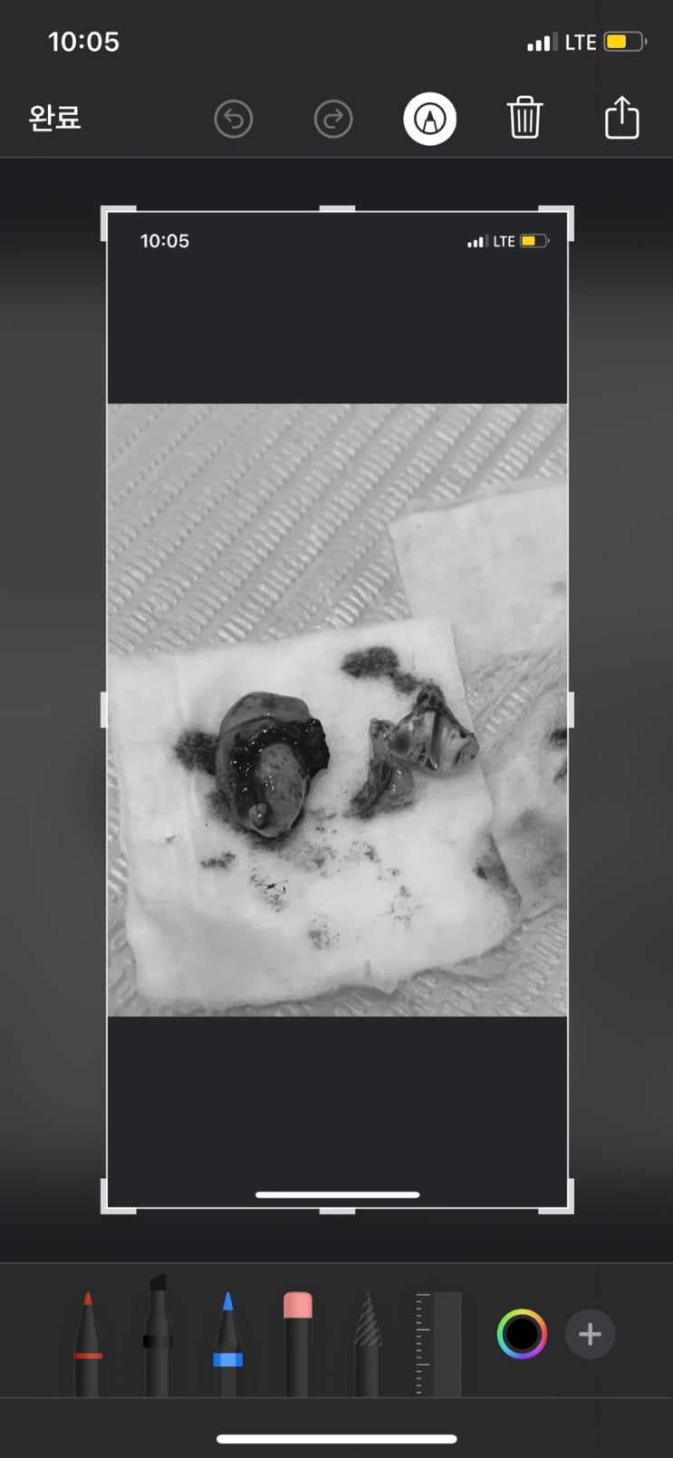  완전매복사랑니와의 이별 브이로그 (대구치과추천,꿀팁)