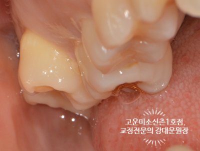  신촌교정/ 고운미소치과신촌1호점 교정전문의어금니 살리기 - 가위교합치료 증례