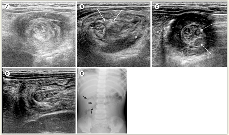  혈변 보고 반복적으로 보채는 아이, 장중첩증(Intussusception). A to Z, 소아과 의사가 다 알려드림
