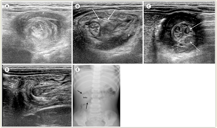 혈변 보고 반복적으로 보채는 아이, 장중첩증(Intussusception). A to Z, 소아과 의사가 다 알려드림